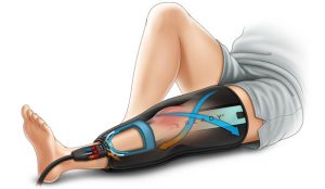 Knee Surgery Recovery Timeline Cold Compression Wrap