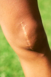 Close-up of young female athletes knee with scar from major knee surgery. scar is several years old.